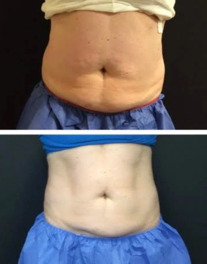 Cooling-sculpting-before-and-after