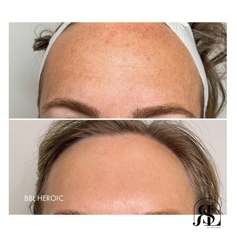 Treat sun damage to the forehead in Chanhassen with The BBL HEROic treatment. View this before and after patient result of BBL HEROic to the forehead.