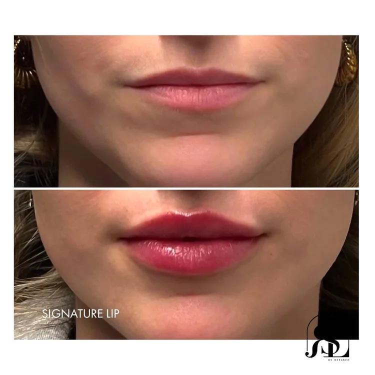 Best Lip Injector in Chanhassen Before and Afters