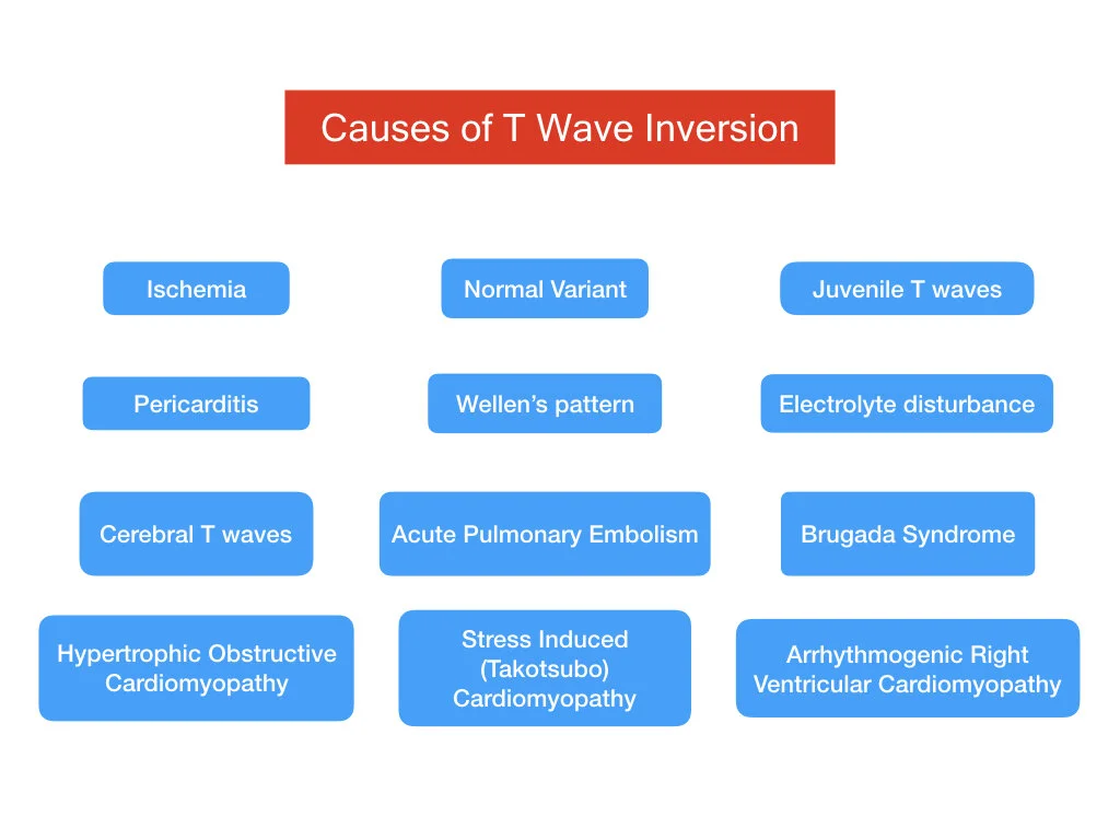 The T Wave — The PR Segment.com