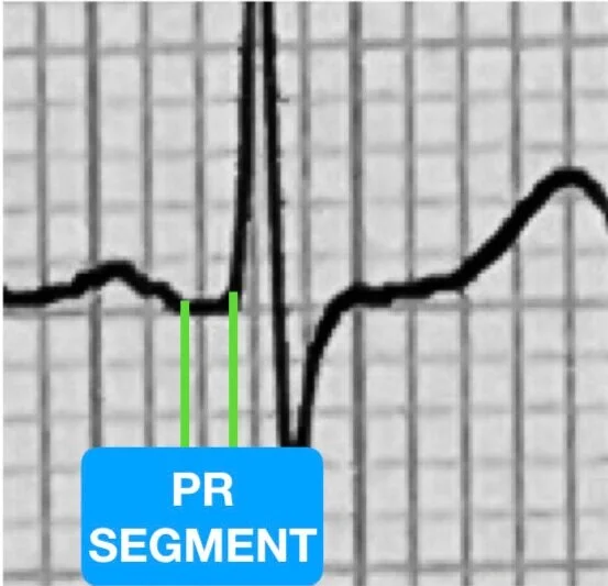 ECG Segments and Intervals — The PR Segment.com