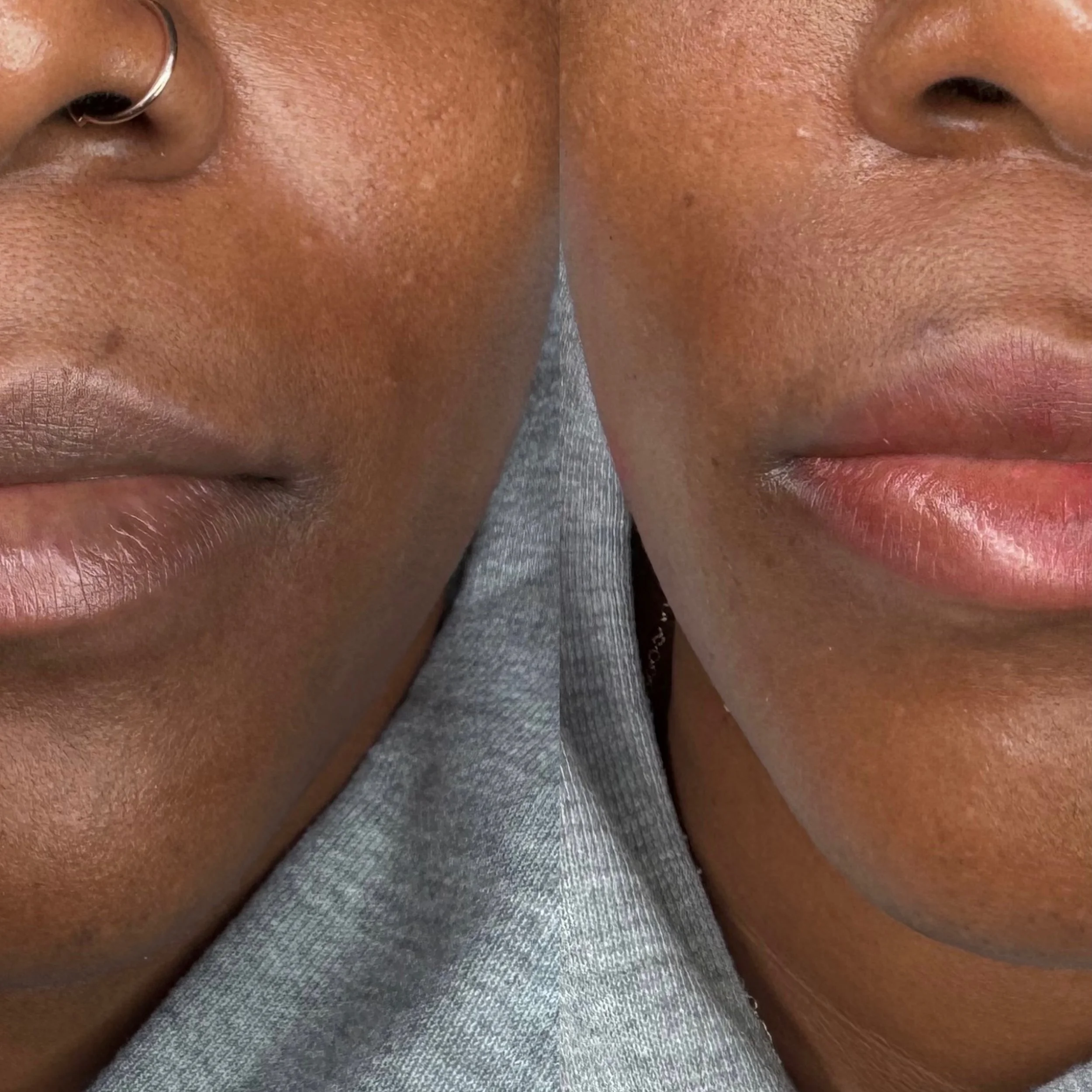 ☆ LIP NEUTRALIZATION 

A few key things to note:

-sometimes it can take up to 3 sessions to see results
-color takes weeks to settle in it is a patient procedure
-results depend on how much melanin the lips carry
-every client is different &amp; req