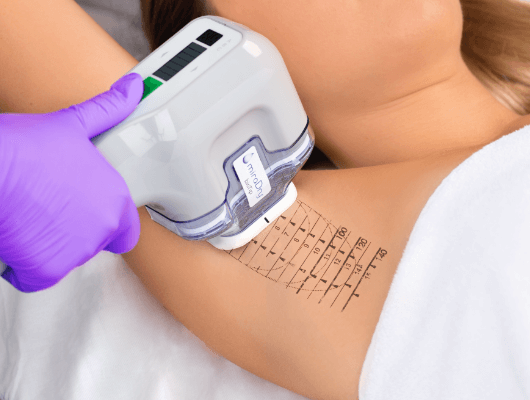 miraDry - A Great Permanent Option for Excessive Underarm Sweating