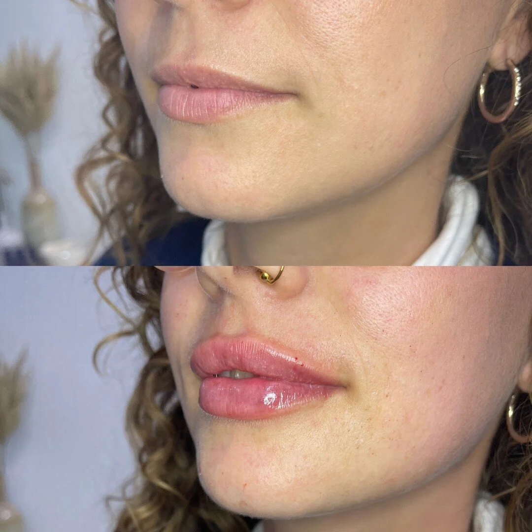 Lucious lips by our talented owner &amp; Registered Nurse Injector 👄 ⠀⠀⠀⠀⠀⠀⠀⠀⠀
@coastalcosmeticclinic⠀⠀⠀⠀⠀⠀⠀⠀⠀
⠀⠀⠀⠀⠀⠀⠀⠀⠀
⠀⠀⠀⠀⠀⠀⠀⠀⠀
#bodiilane #coastalcosmeticclinic #networking #coworkingspace #workspacegoldcoast #teamspace #goodvibes #collaborative