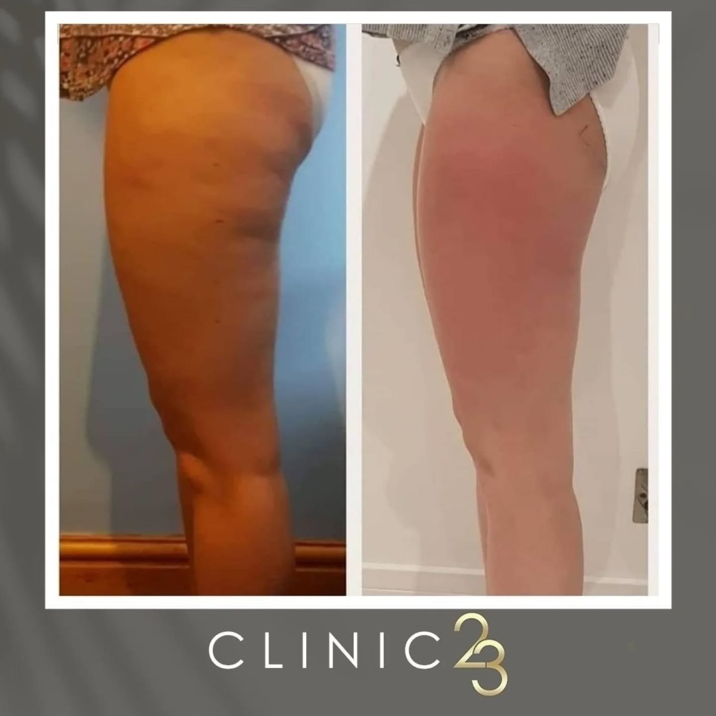 Want to improve the appearance of your cellulite?

We can help!

Most people have it and it's one of the things that's hard to reduce it on it own but with our 3D Lipo treatments we can reduce cellulite and really smooth out the appearance of it. We 