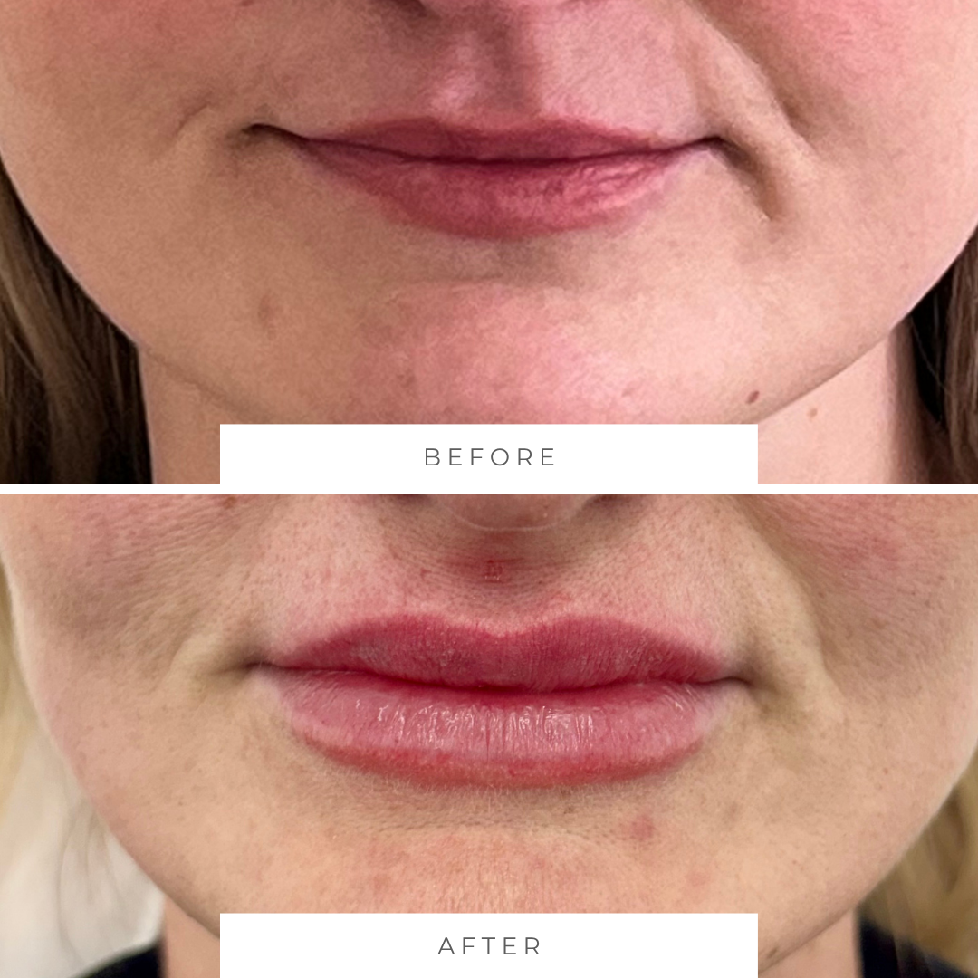 Close-up of a person's lips showing a before and after comparison. The 'before' image shows thin, dehydrated lips that are out of balance with natural features, while the 'after' image shows lips that are fuller and with a more defined shape.