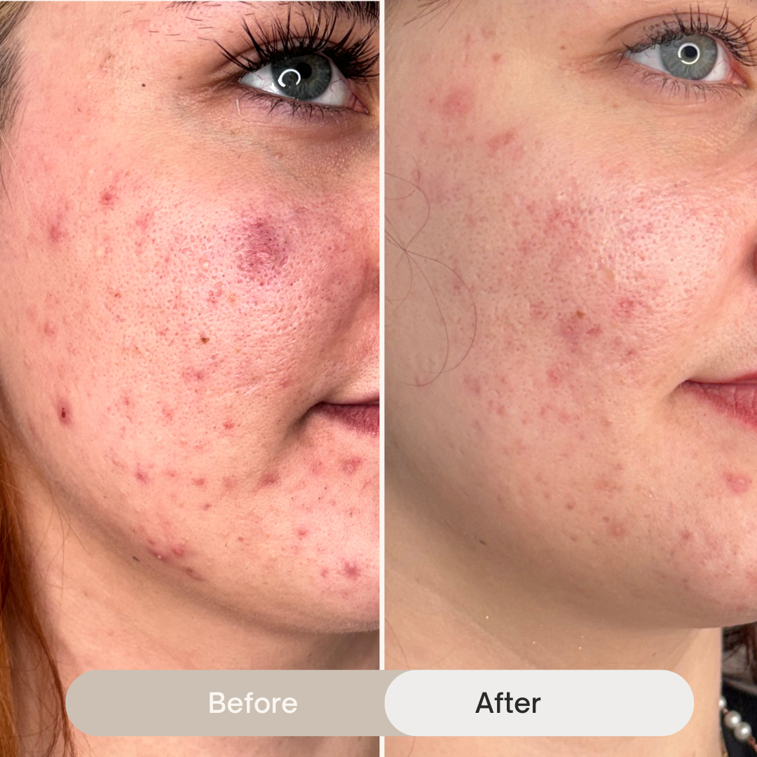 Close-up of a woman's face showing improved skin condition with fewer blemishes and smoother skin after treatment, compared to a previous state with more acne and redness.
