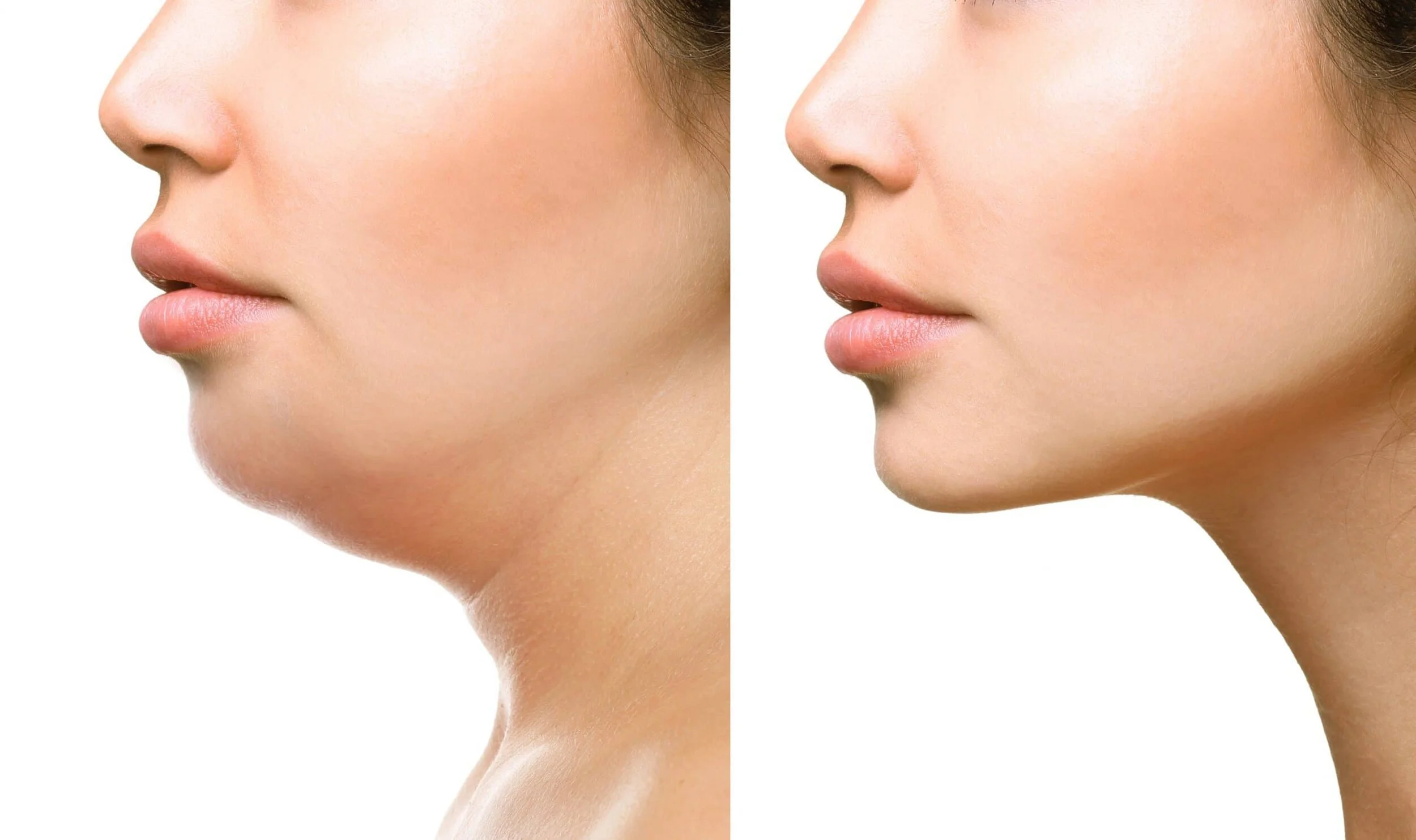 Bloomfield Aesthetics Aqualyx Fat Dissolving Injections Warrington Cheshire