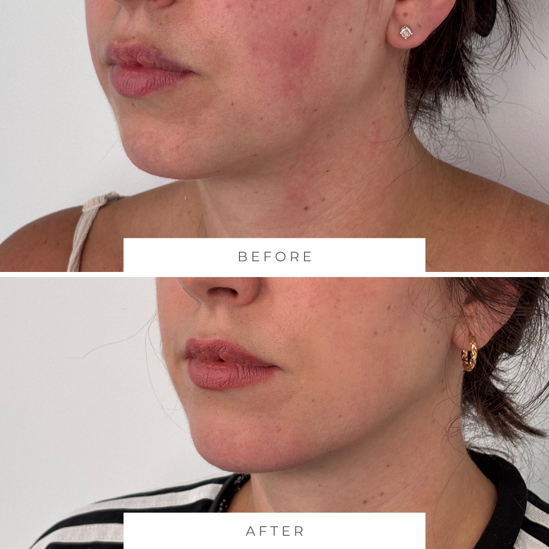 Comparison of a woman's face showing skin before and after lower face treatment. The "before" image shows lack of definition and early signs of lower face heaviness, while the "after" image shows a more contoured jawline and natural chin projection.