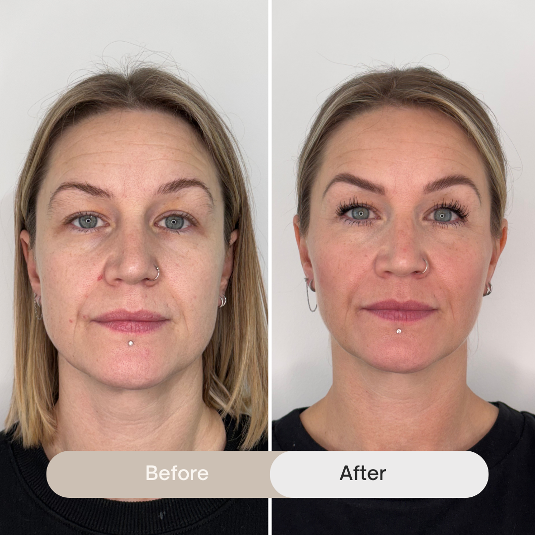 Side-by-side comparison of a woman's face before and after full-face harmonisation treatment; the after photo shows a slimmer face, more defined features and an improved overall appearance.