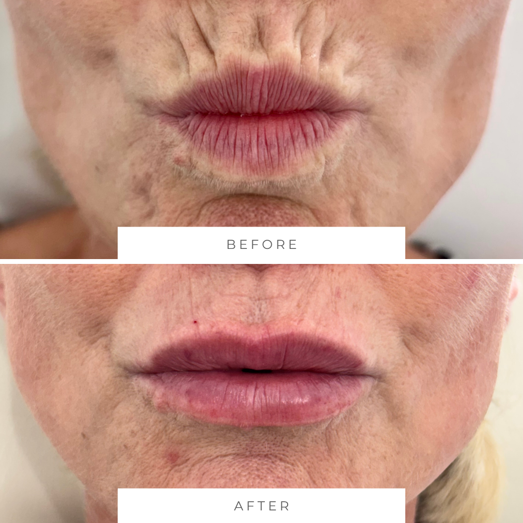Close-up of lips before and after cosmetic lip enhancement. The 'before' shows natural lips with prominent barcode or 'smokers' lines, and the 'after' shows fuller, smoother lips with improved texture.