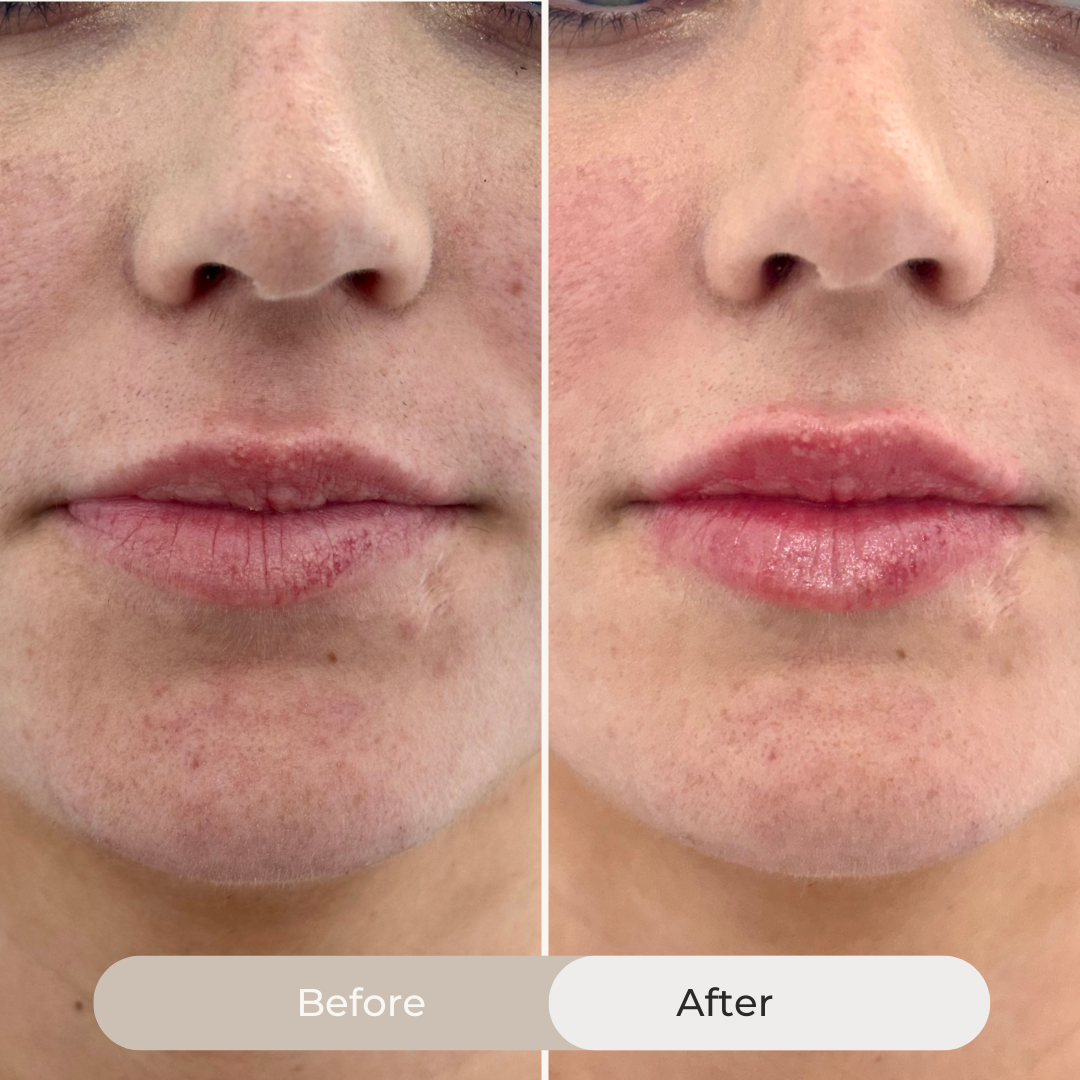 Side-by-side comparison of a person's lips and surrounding skin showing a before and after of lip enhancement with the after image displaying fuller, more defined and hydrated lips.