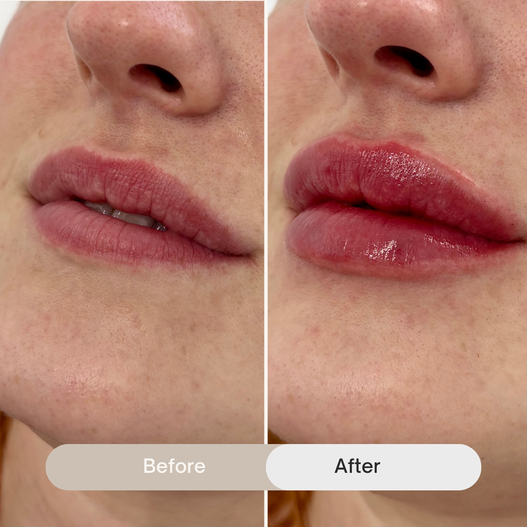 Close-up side-by-side comparison of lips before and after a natural lip filler treatment, showing smooth, plump, and hydrated lips post-treatment.