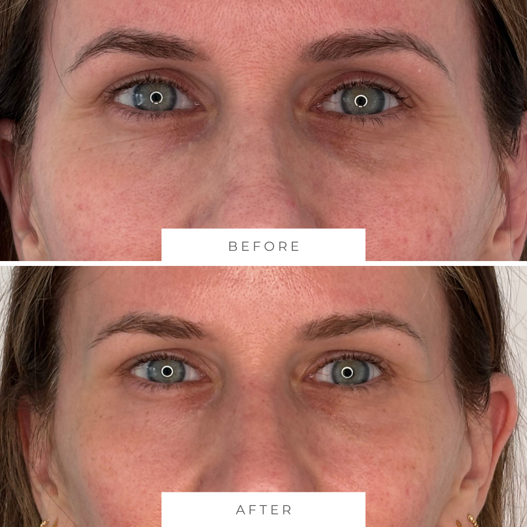 Close-up of a woman's face showing a before-and-after comparison of under eye treatment. The 'before' image shows darker under eyes with crepey skin, while the 'after' image shows lighter under eyes and improved skin quality.