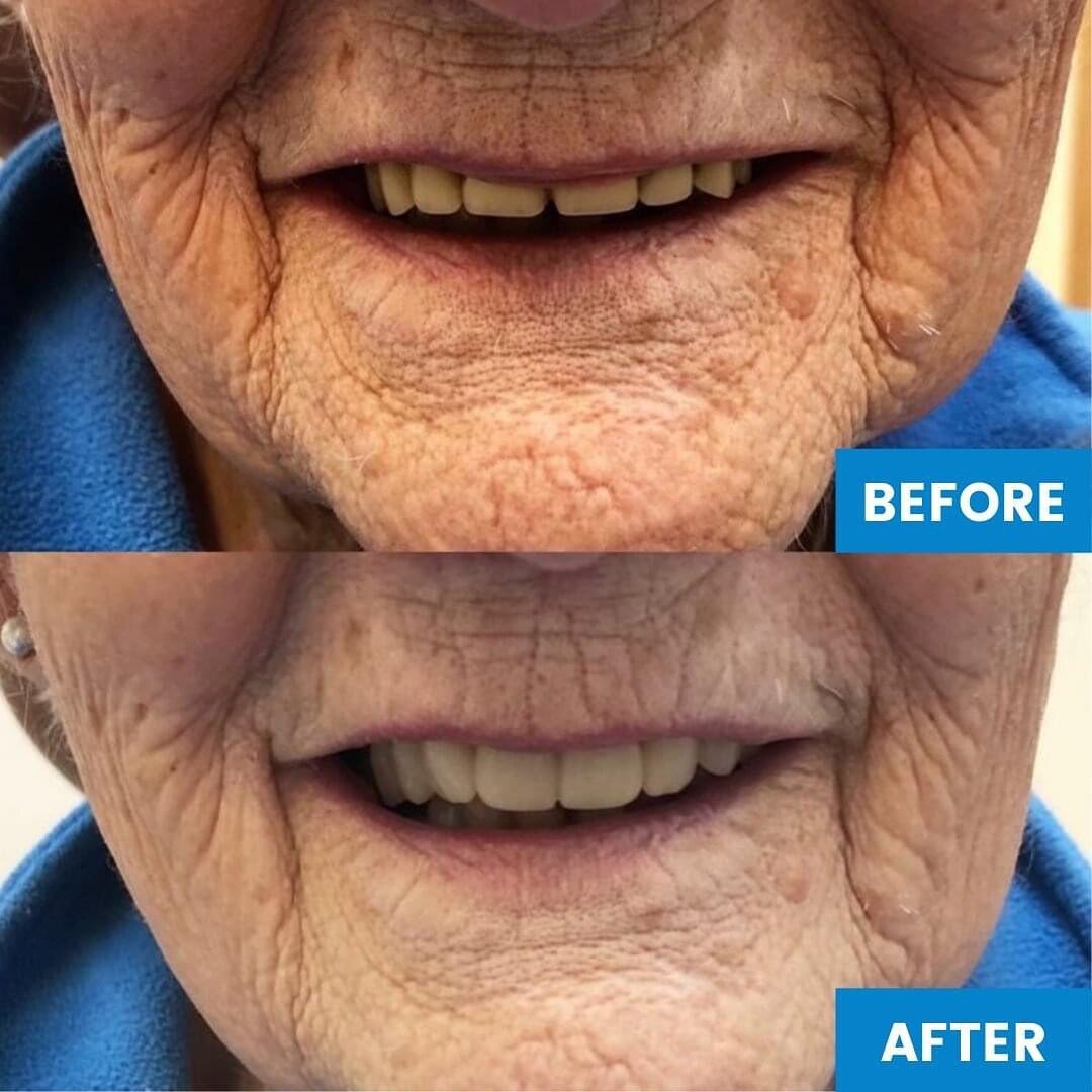 Dentures can make you feel out of sorts. Everyone deserves natural-looking teeth &ndash; even if they don&rsquo;t have their own.

Say goodbye to feeling self-conscious.

With dentures from North Care Denture Design, you&rsquo;ll finally feel like yo