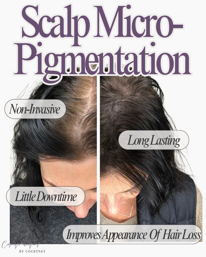Feeling self-conscious about thinning hair? You don&rsquo;t have to just &ldquo;accept it.&rdquo;⁠
⁠
Scalp micropigmentation is a simple, low-downtime treatment that creates the look of fuller hair instantly. It&rsquo;s also the perfect complement wh