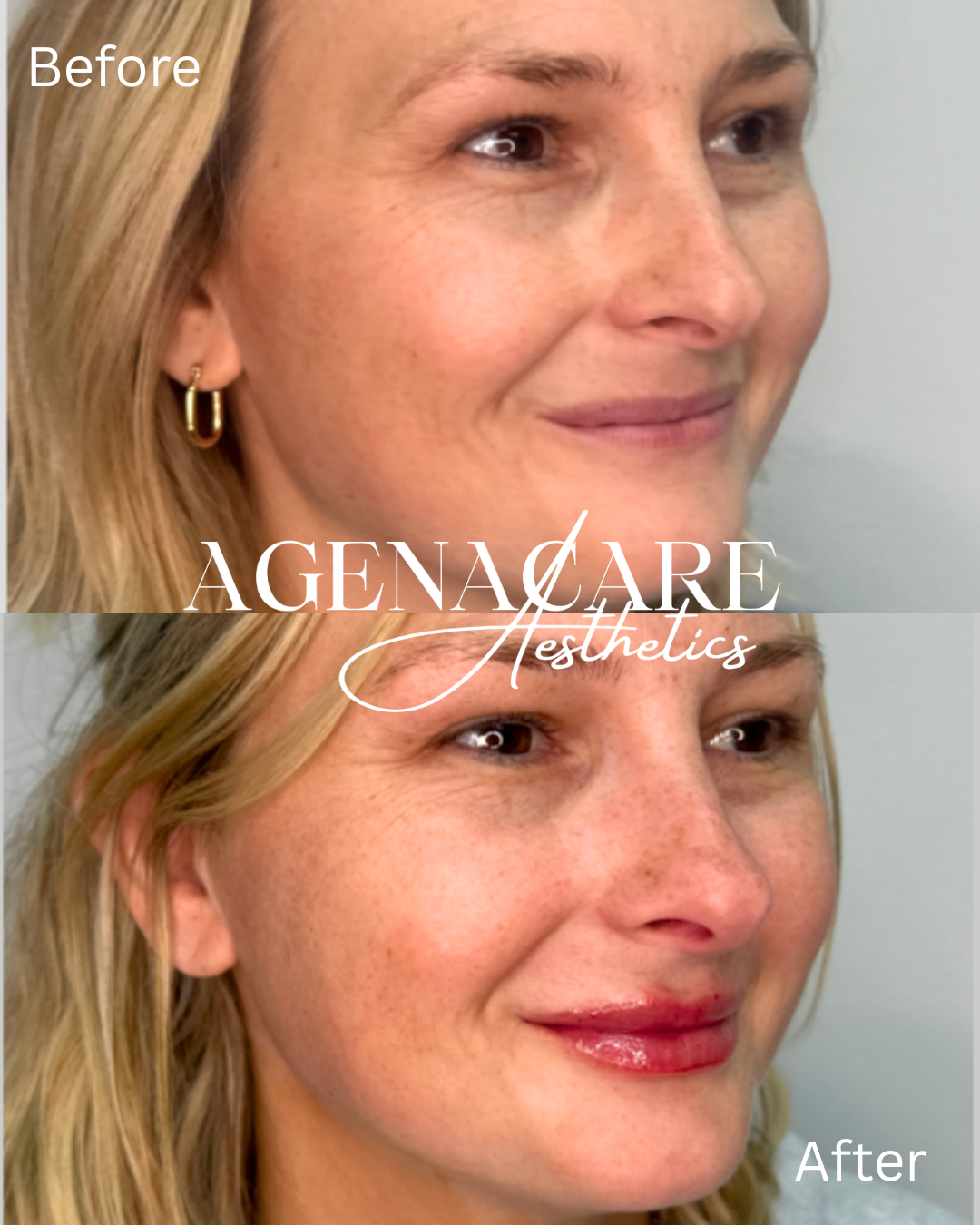 Lips- before and after.png