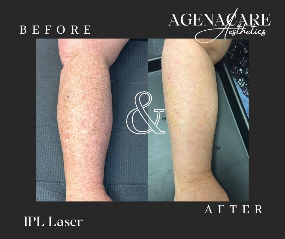 IPL is a common procedure used to treat pigmented, vascular and textural lesions, mainly on the face but also on the neck, chest, and back of hands.

Check out this amazing before and after of one of our patients having received just 1 treatment! 😮?