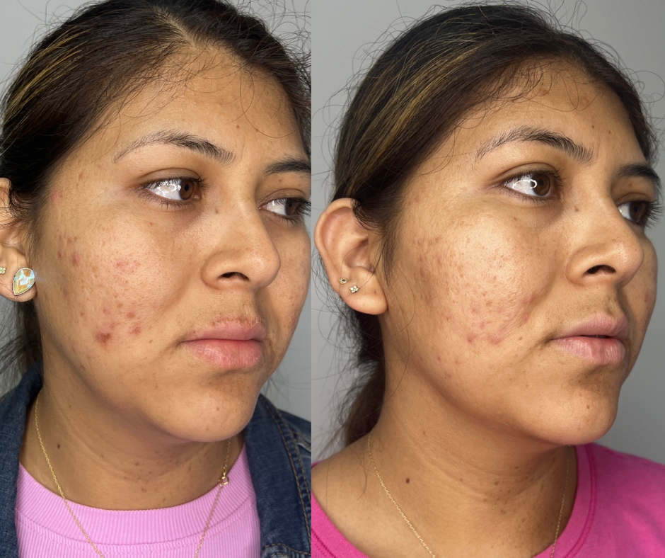 Comparison of a woman's face before and after applying lip gloss, with visible skin issues in the first image and improved skin in the second.