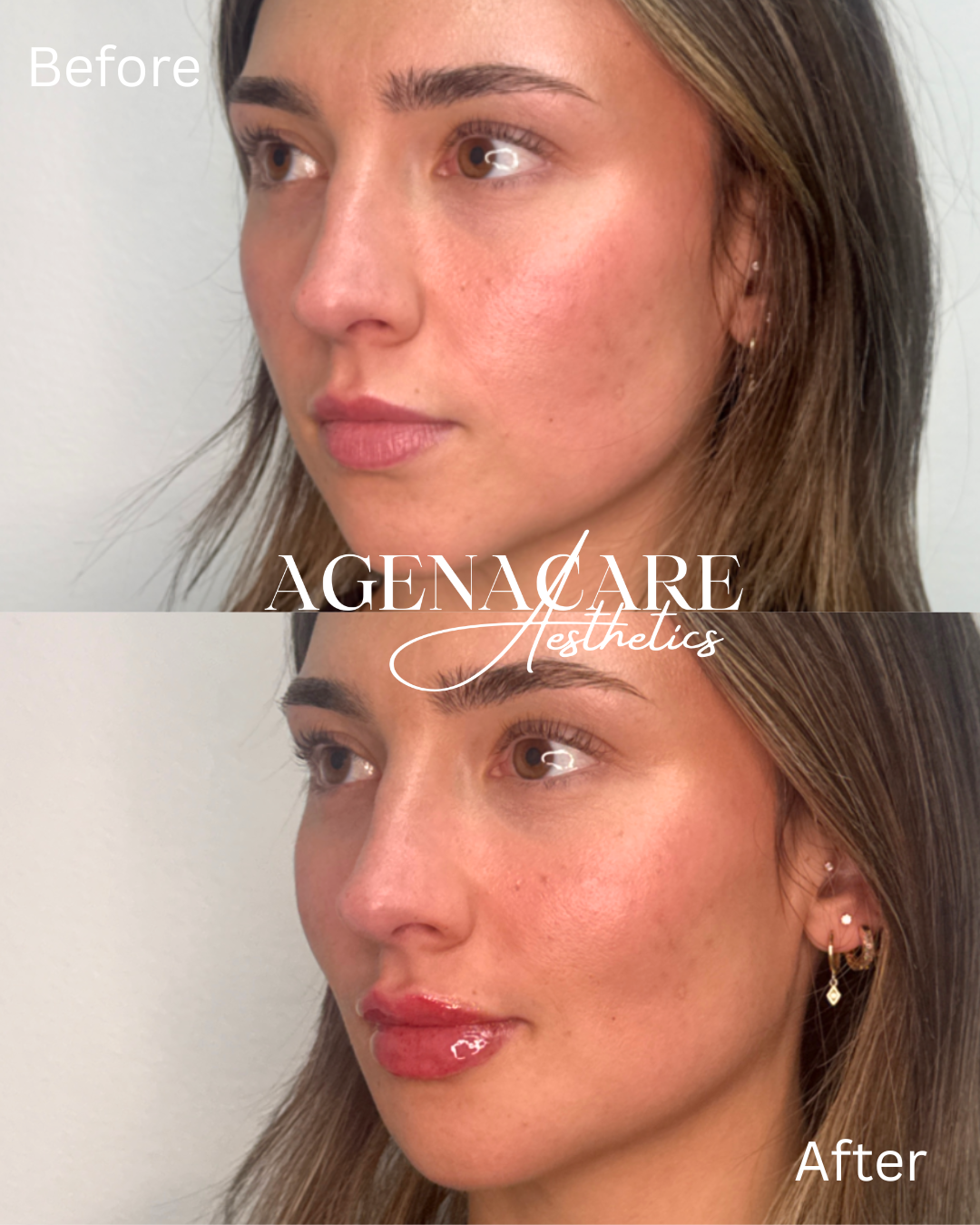 before and after filler (2).png