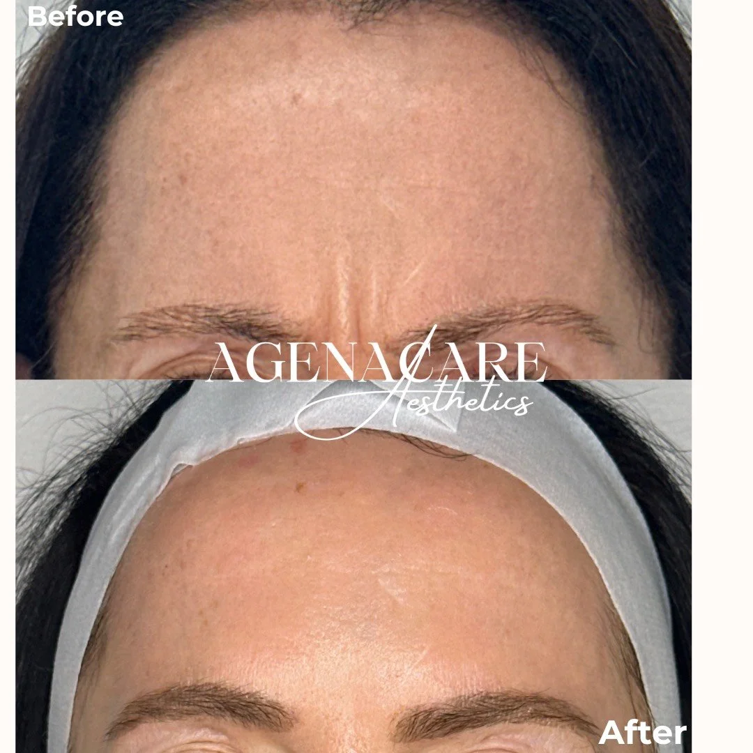 Before and after images of a woman's forehead showing the results of a cosmetic procedure to reduce wrinkles and improve skin texture.