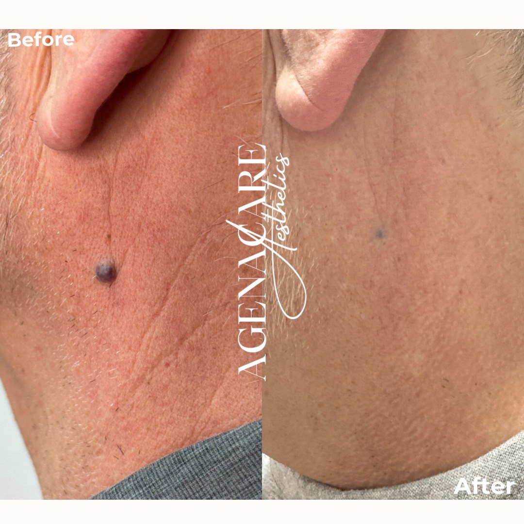Skin tag removal before and after of a patient's neck mole