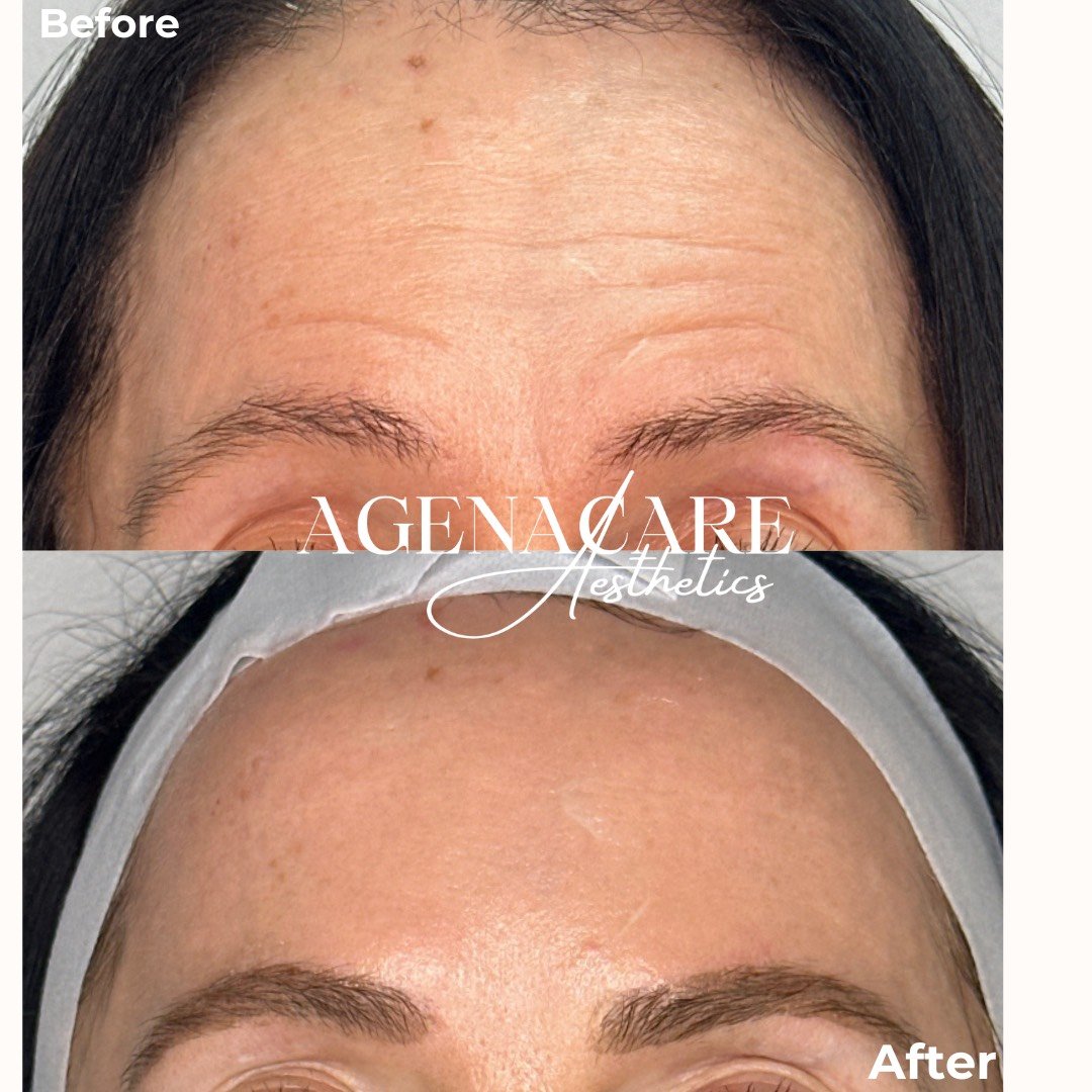Close-up comparison of a woman's forehead and eyebrows showing before and after cosmetic treatment, with the before image having visible fine lines and the after image having smoothed skin.