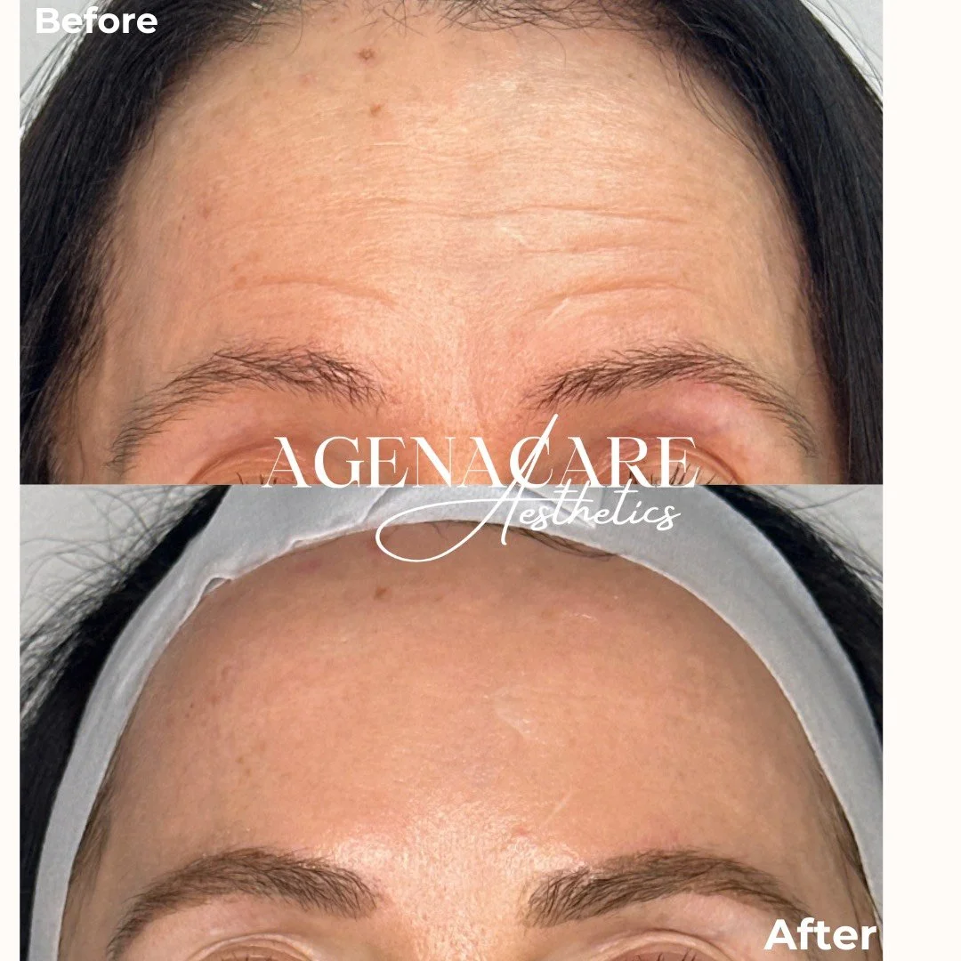 Botox treatment before and after image, with glowing skin improvements and tighter facial features with less visible movement in the bottom image.