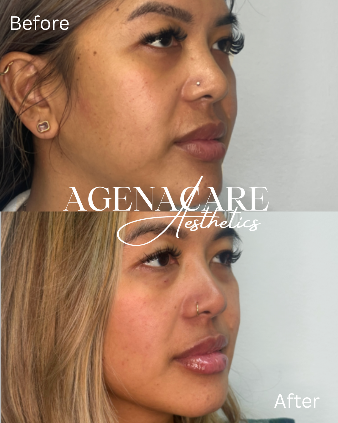 Lip Filler B&A 4.16.26.png