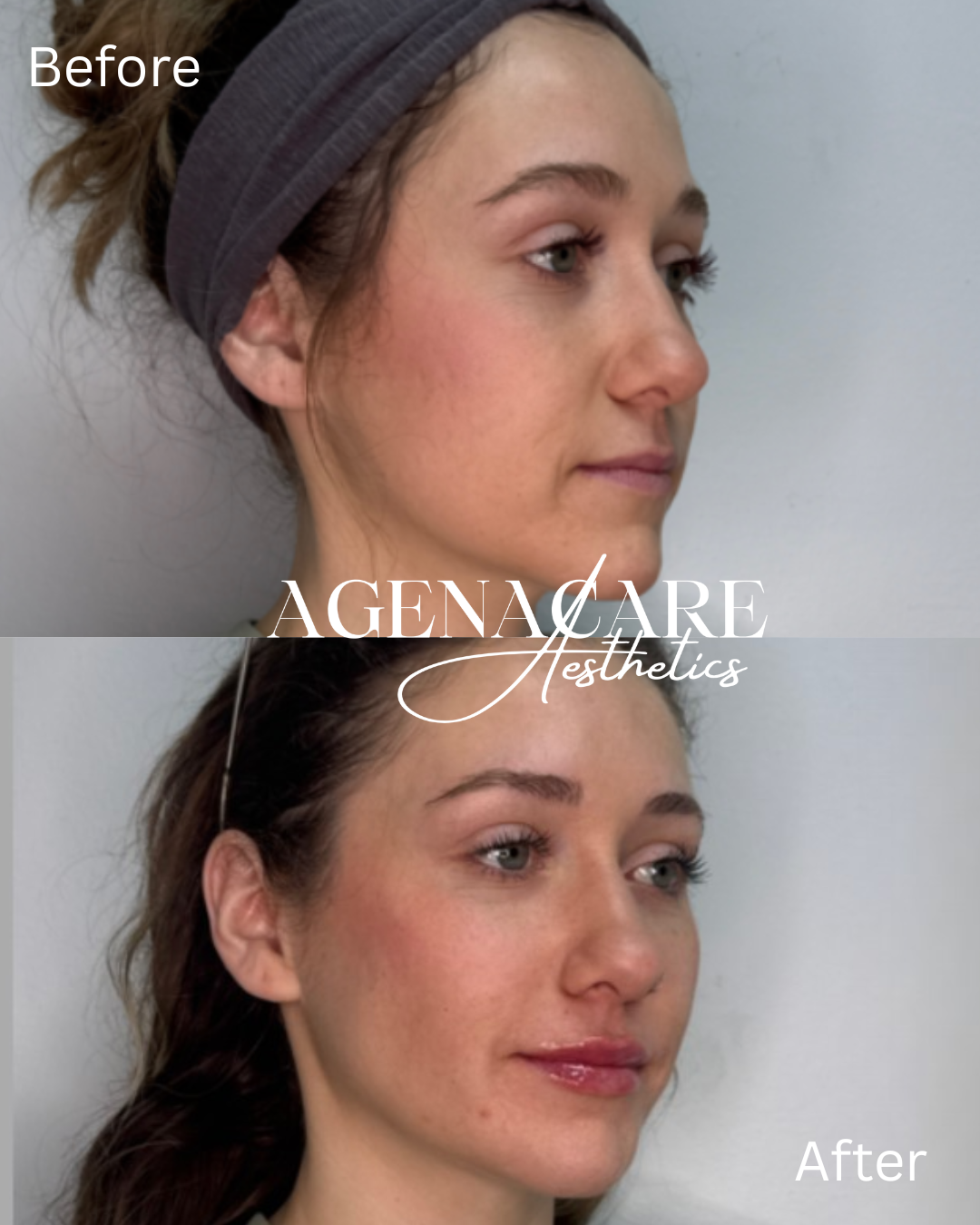 before and after- skinvive and lip filler - Copy.png