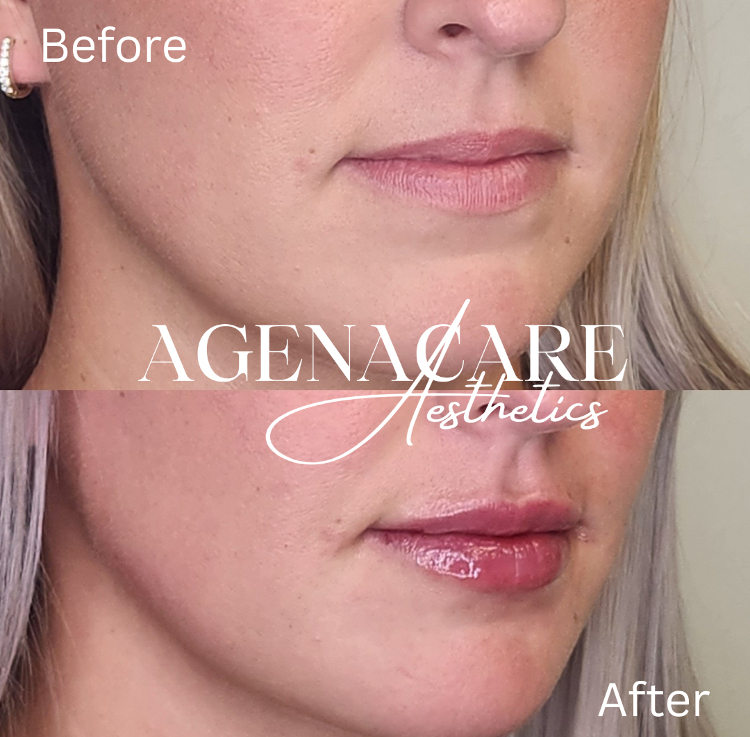 Dermal Filler- lips4.png