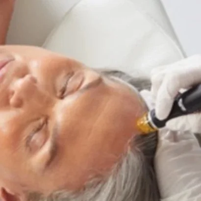 A woman receiving a cosmetic scalp and hair growth treatment with a device on her forehead, lying down with eyes closed.
