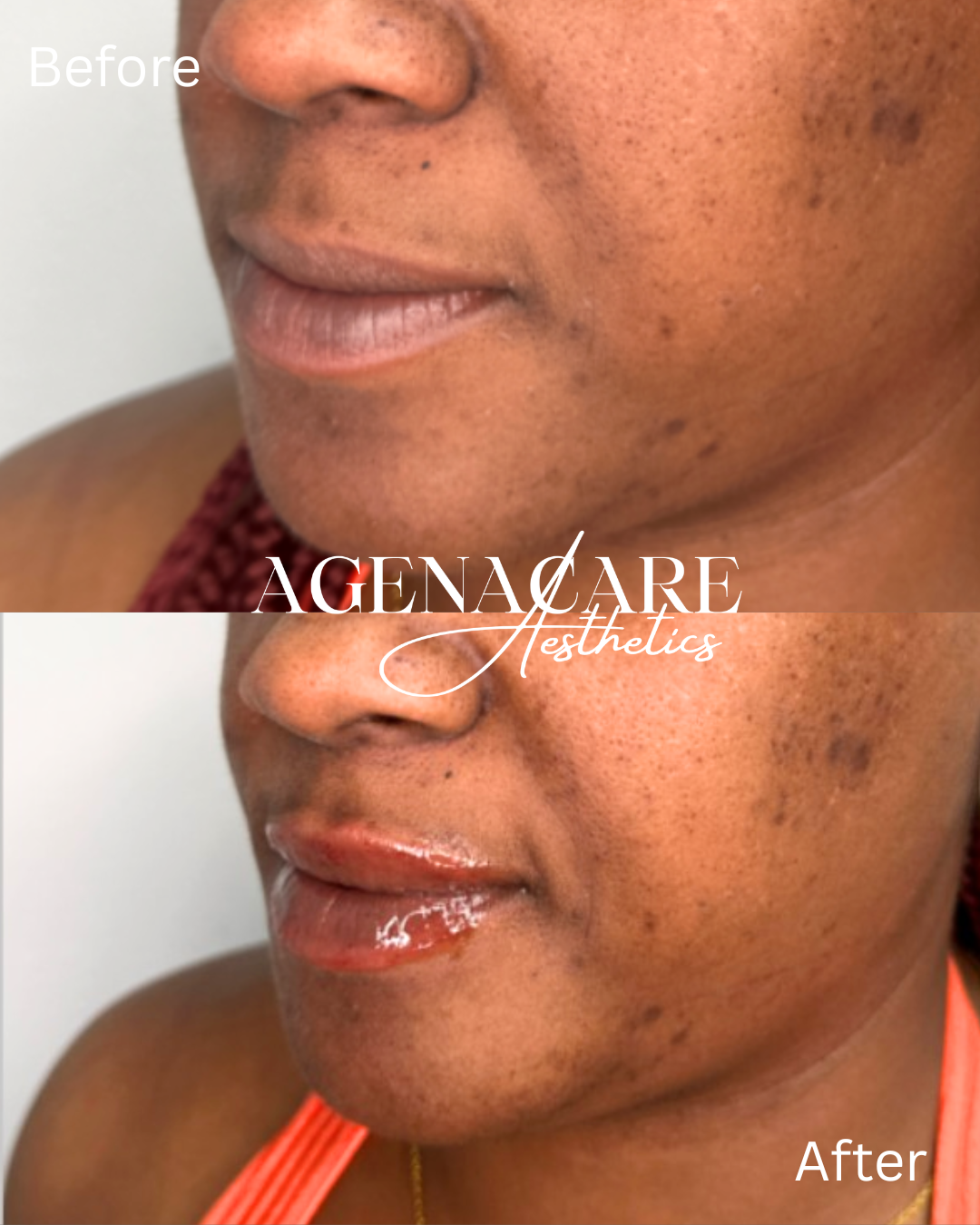 lips- b and a 4-20.png