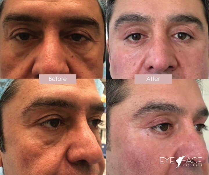 Do your eyes look tired all the time? They don't have to!💫⠀
⠀
➕ Treatment: Eyelid tightening &amp; conservative 4-lid blepharoplasty⠀
⠀
➕ Who?: Male patient in his 50's⠀
⠀
➕ Why?: Patient wanted to treat his &quot;tired looking&quot; eyes and appear