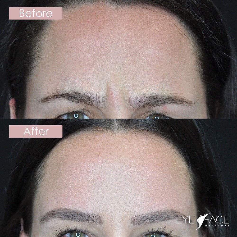 ✨That fresh Botox feeling.✨

Whether you're receiving Botox for preventative measures or to address deeper lines and wrinkles, our main goal is to provide you with a a natural and radiant result.

-------

➕ Email: info@eyefaceinstitute.com
➕ Phone: 