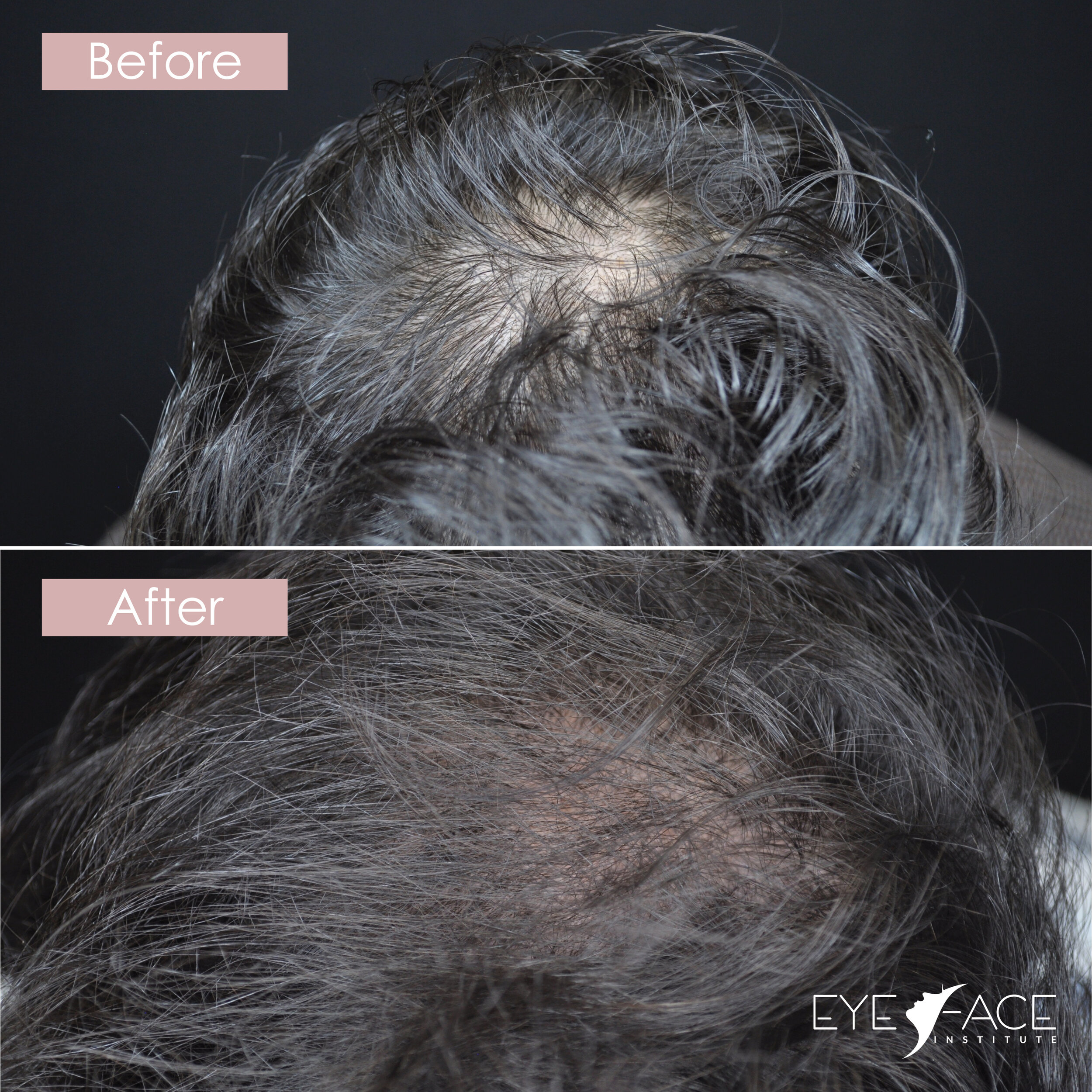 Skin Care u0026 Hair Regeneration Treatments in Toronto u2014 Eye Face