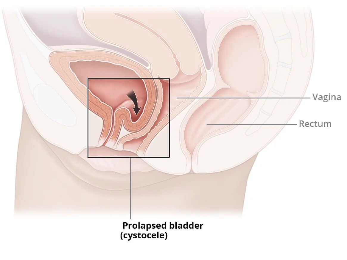 Side view of female pelvic anatomy showing a prolapsed bladder (cystocele) pressing into the vaginal canal, with labels for the vagina and rectum.