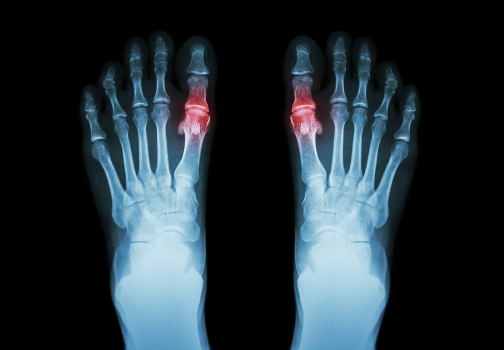 Uitvoerbaar Dwingend Gedwongen 7 Common Types of Foot and Ankle Surgery — Dr. Elton