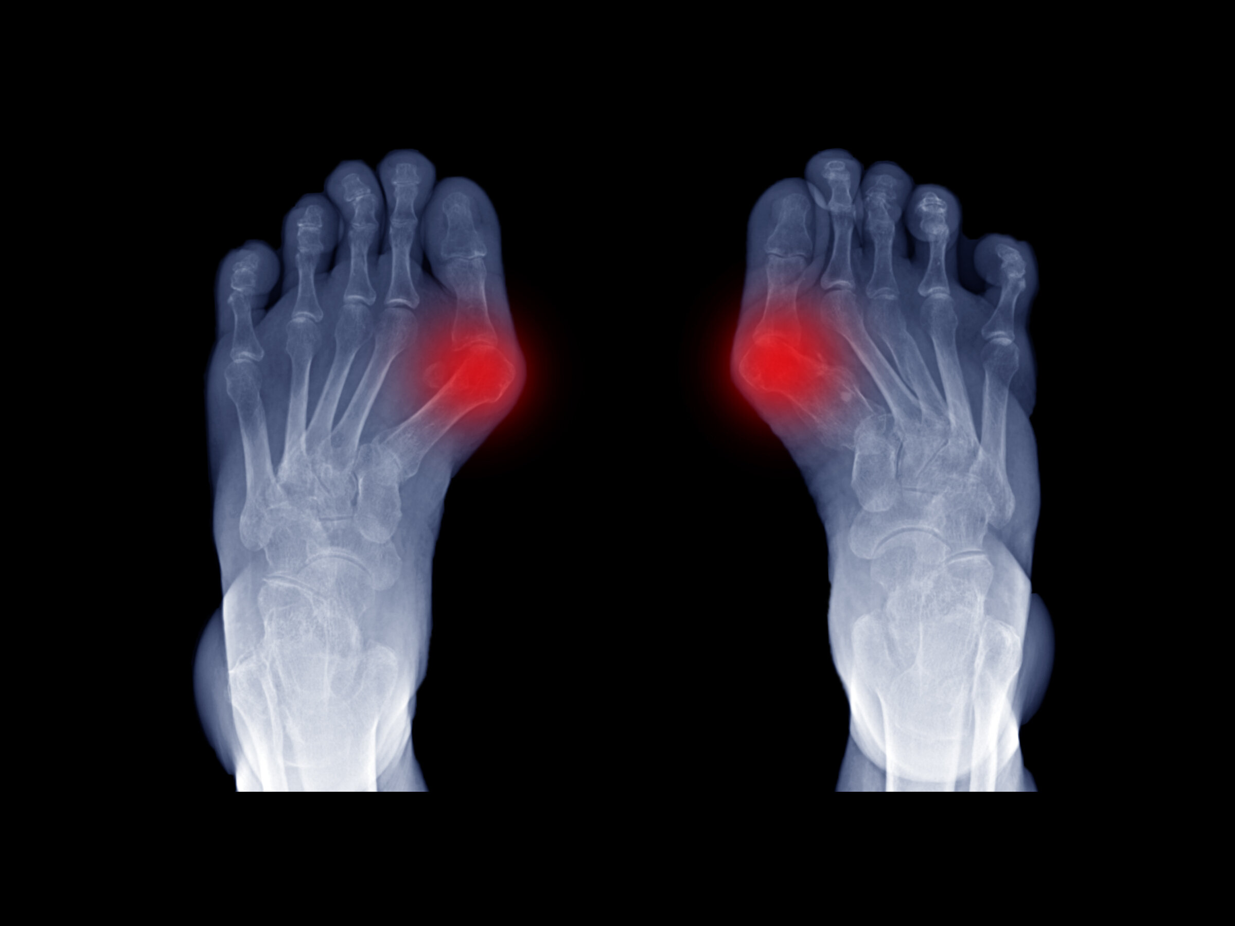 How (and When) to Treat Your Bunions