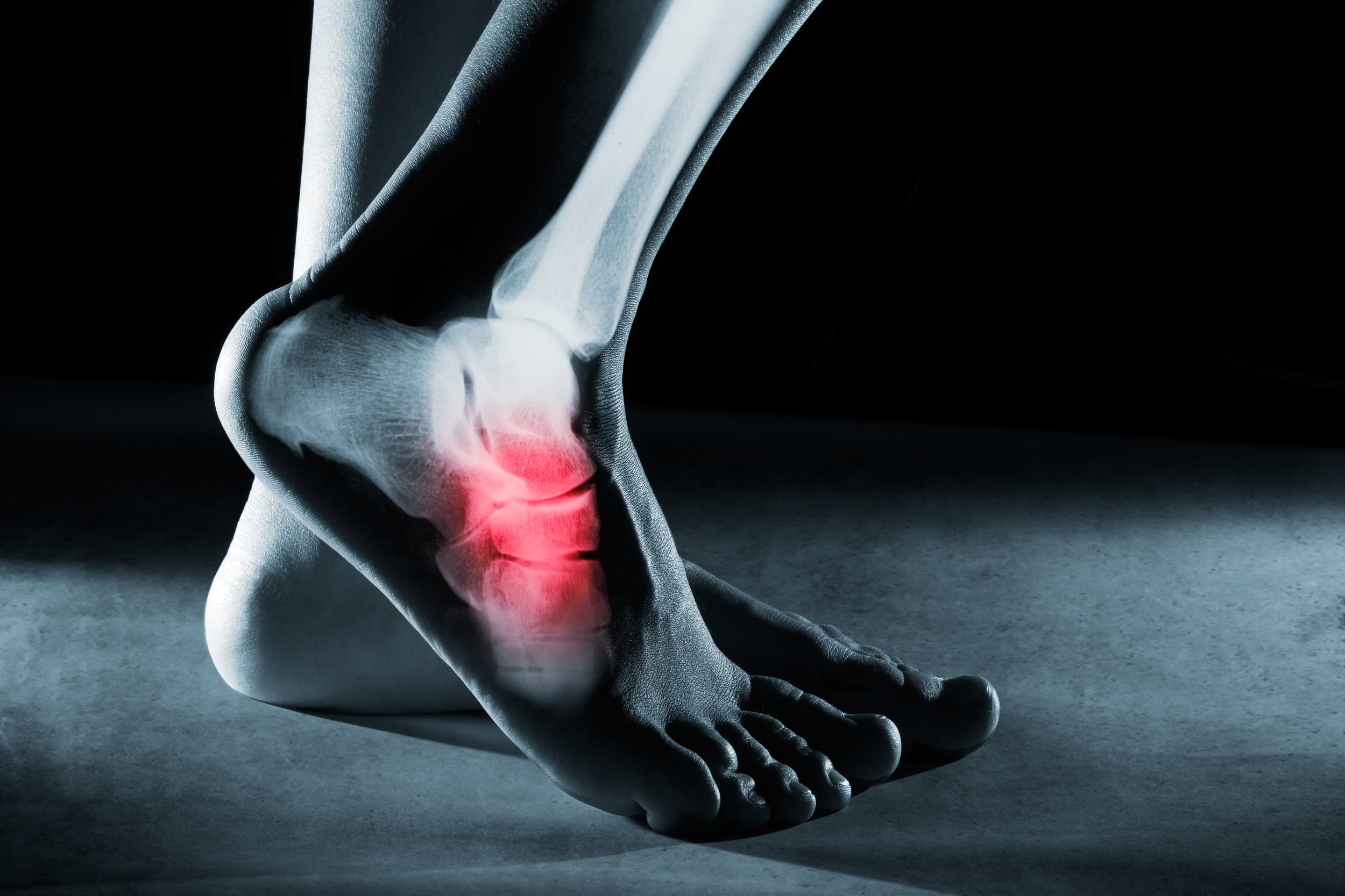 Get Rid of Heel Pain (And Get Back in the Game) | Precision Foot and Ankle,  P.A.