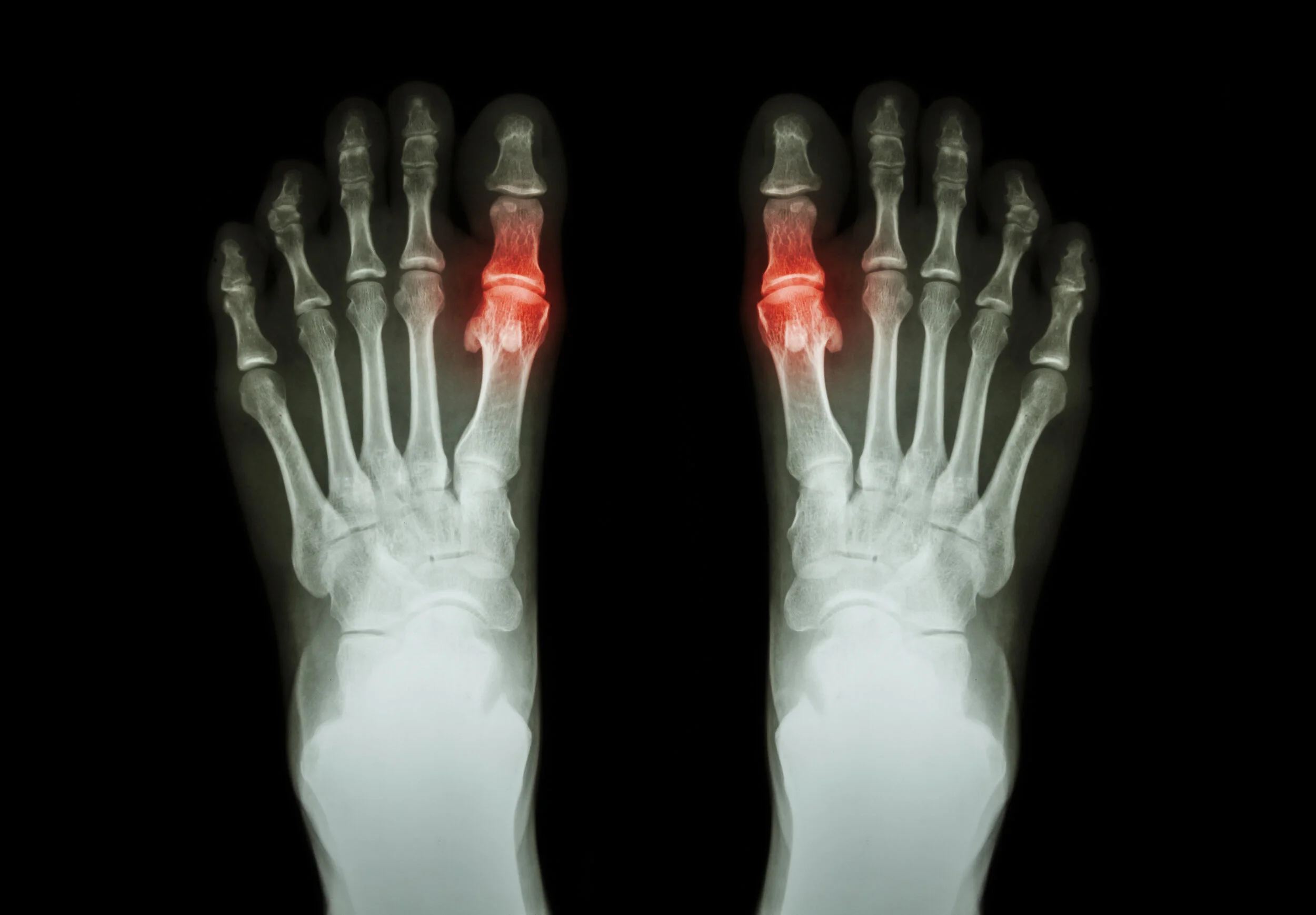 What To Do About Toe Arthritis