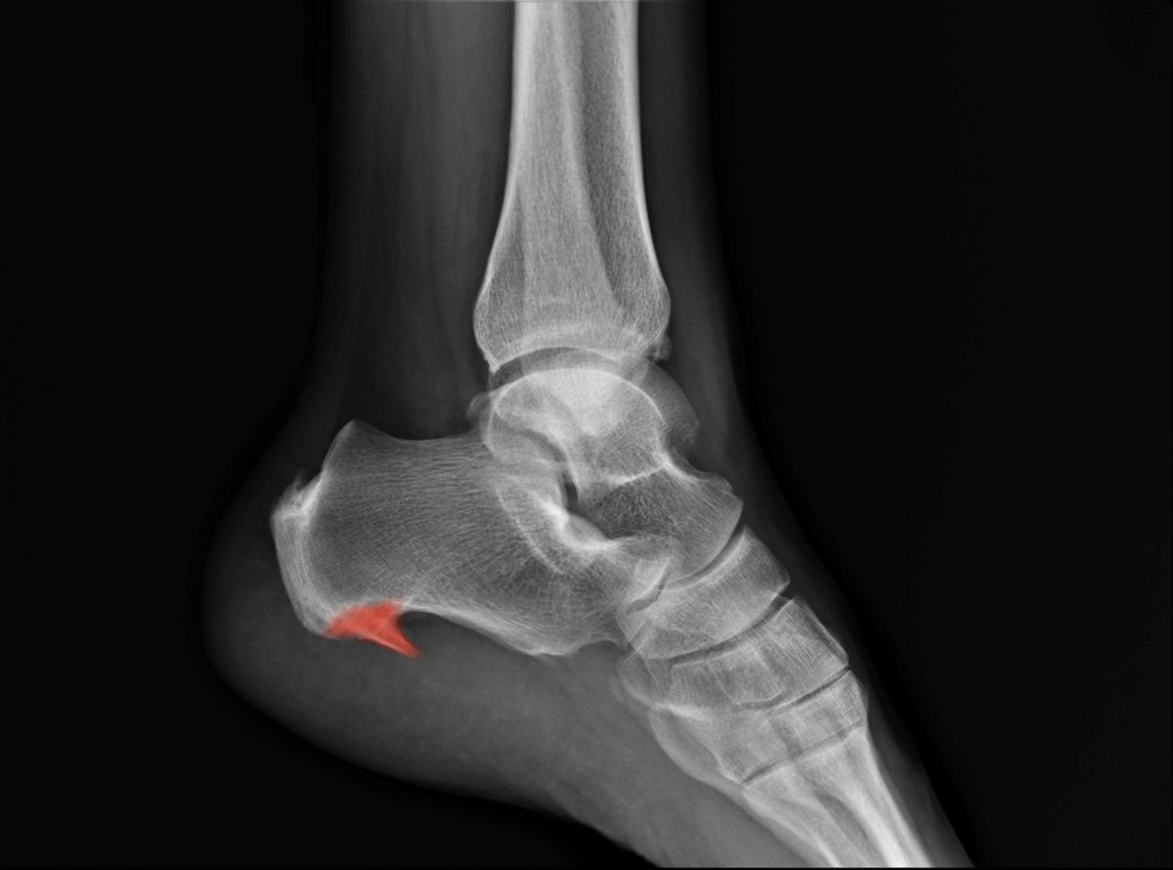 Bone Spurs of the Foot - Feet For Life - Bessemer Foot Doctor