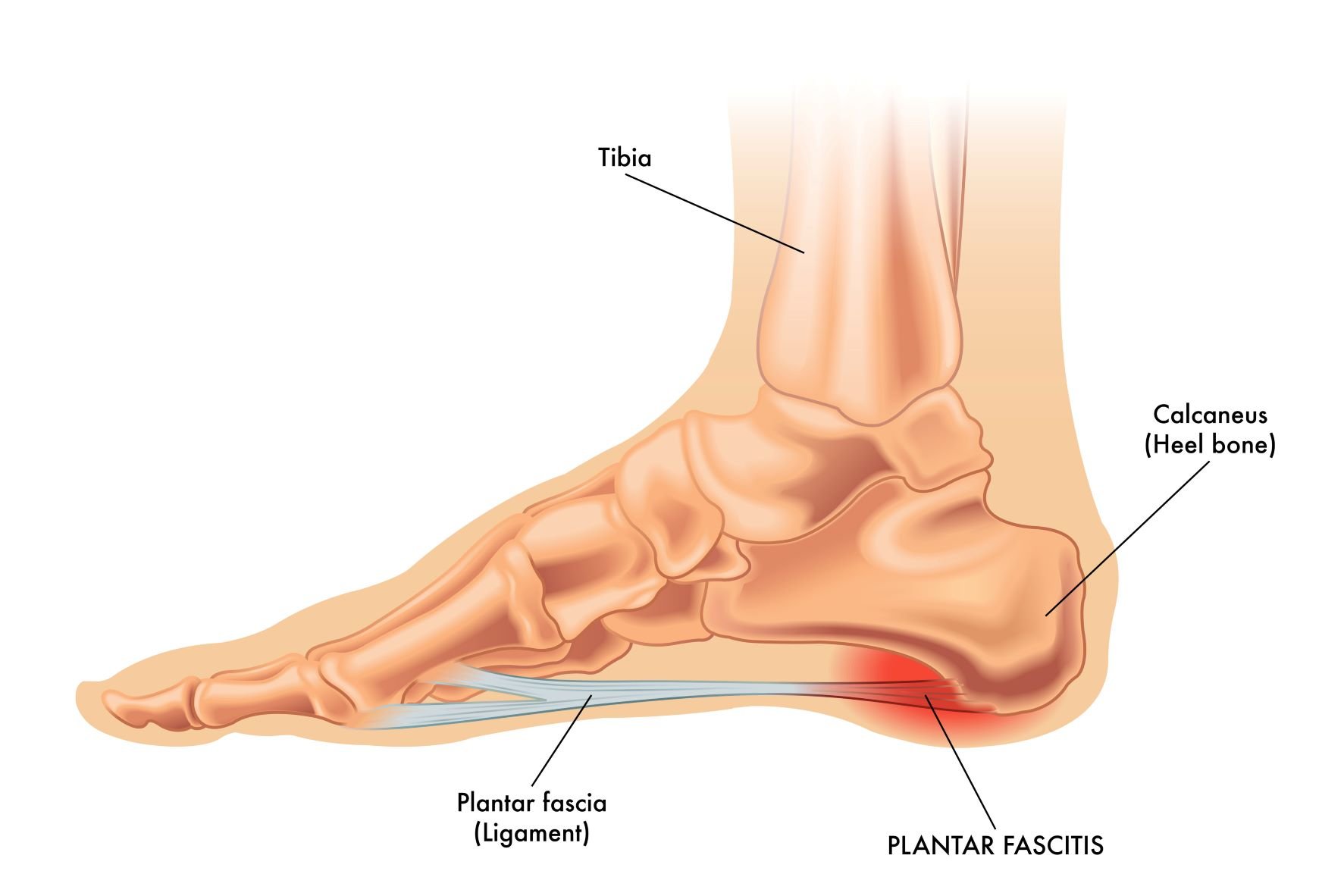 Plantar Fasciitis and Heel Spurs Understanding the Connection Dr. Elton