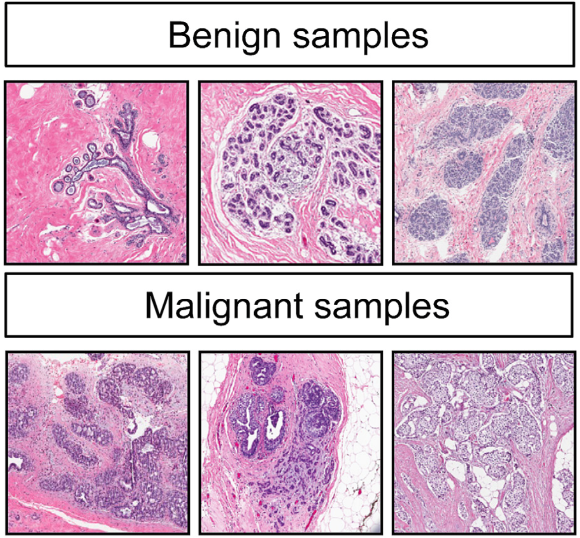 Figure 2: Example annotated images from histology slides for both benign or normal breast tissue and malignant or cancerous breast tissue.