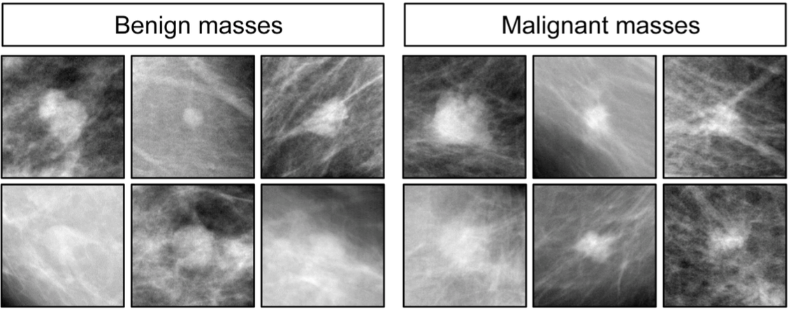 Figure 3: Example annotated images from mammograms for both benign or normal masses and malignant or cancerous masses.
