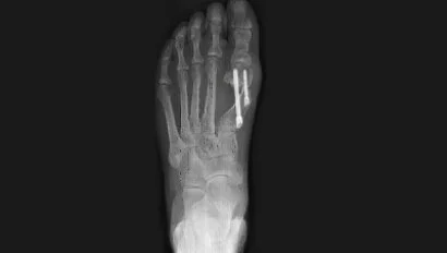 MICA-Chevron-Osteotomy.jpg