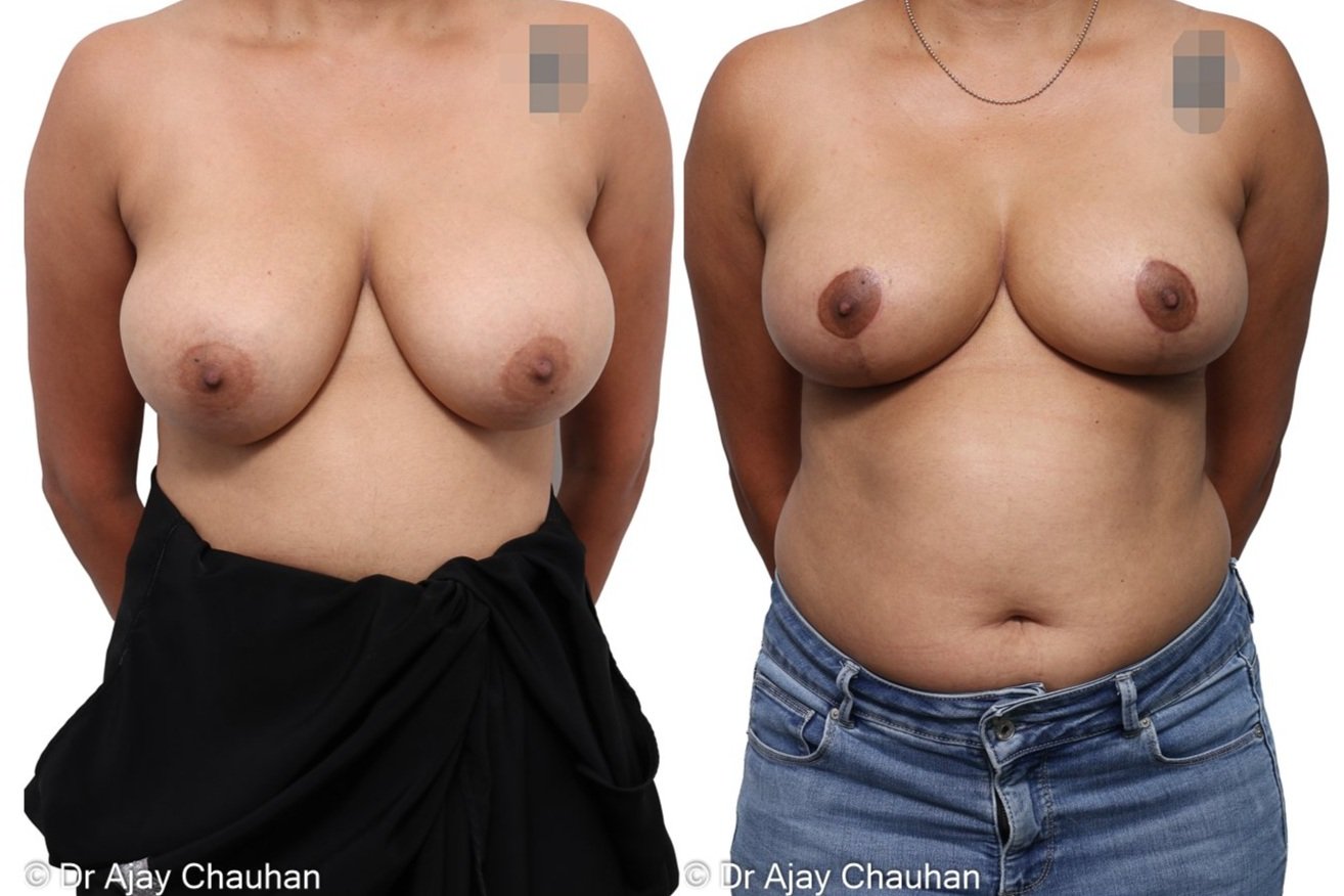 38292+10+WEEKS+POST+BILATERAL+BREAST+REDUCTION+DR+AJAY+CHAUHAN+AR+PLASTIC+SURGERY2.jpg