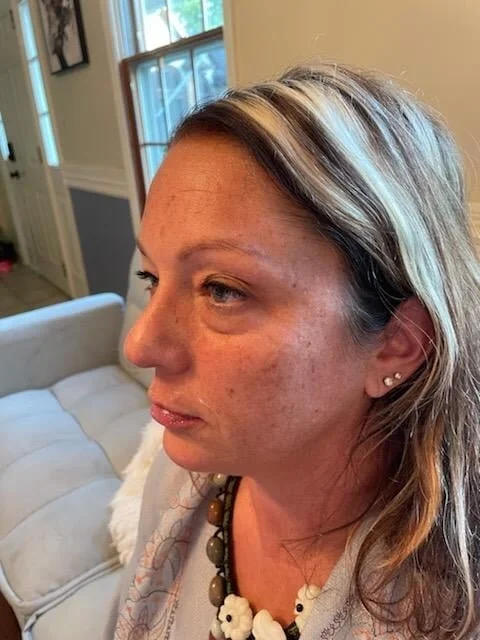 Close-up of a woman with light skin and light brown hair, showing signs of skin redness and irritation on her face, sitting indoors with windows and furniture in the background.
