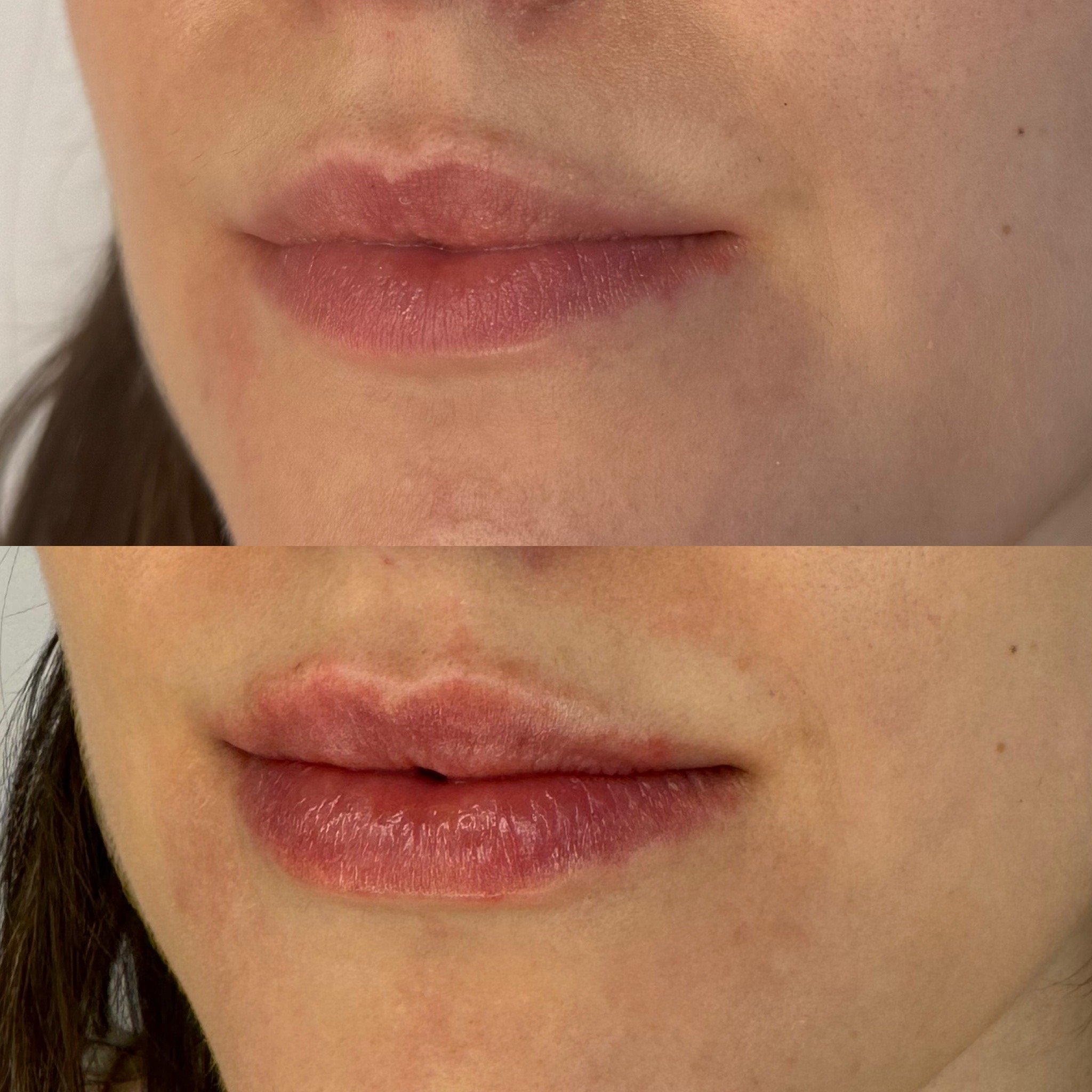 Lip Results