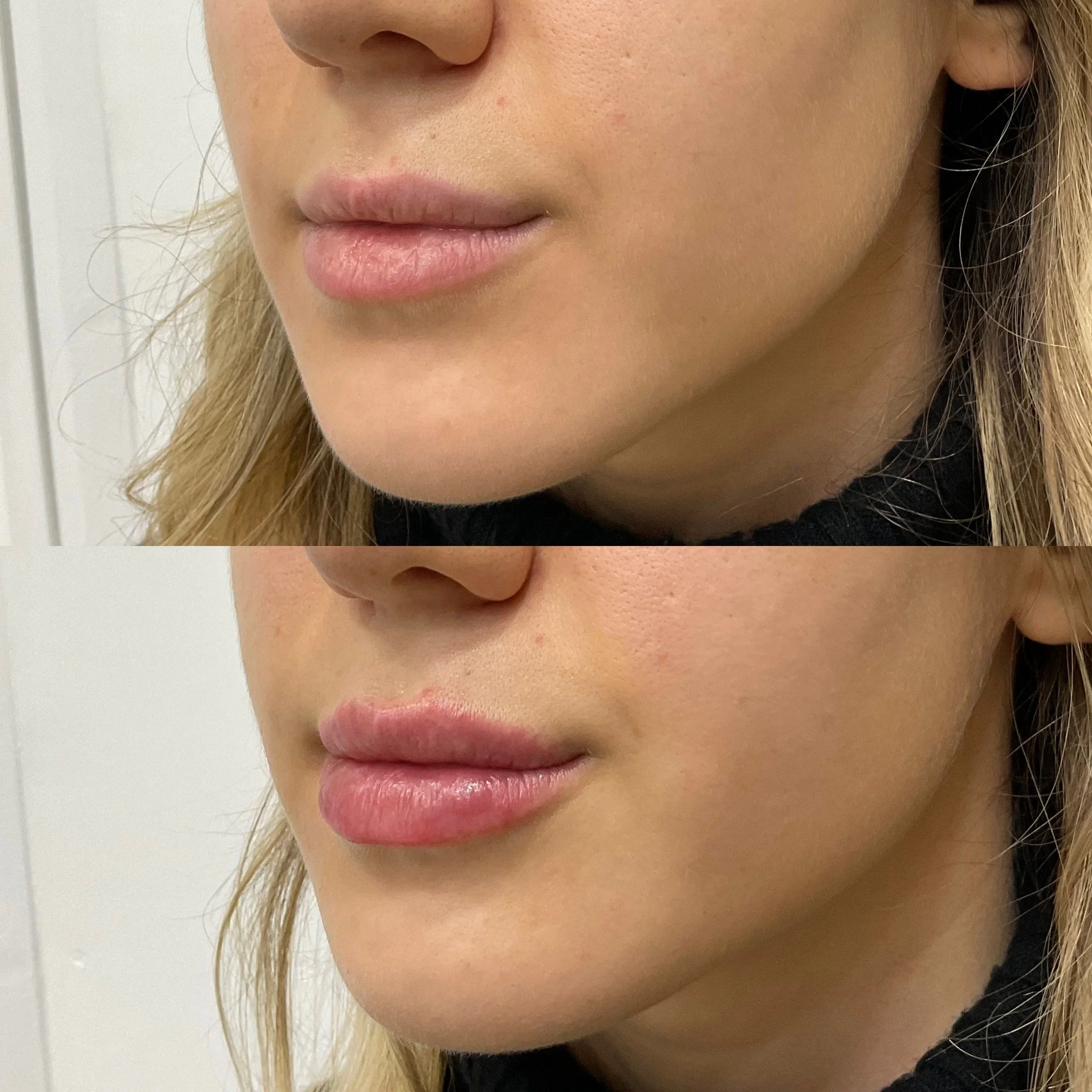 Lip Results
